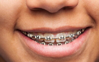 ¿Cómo saber si necesitas una ortodoncia?