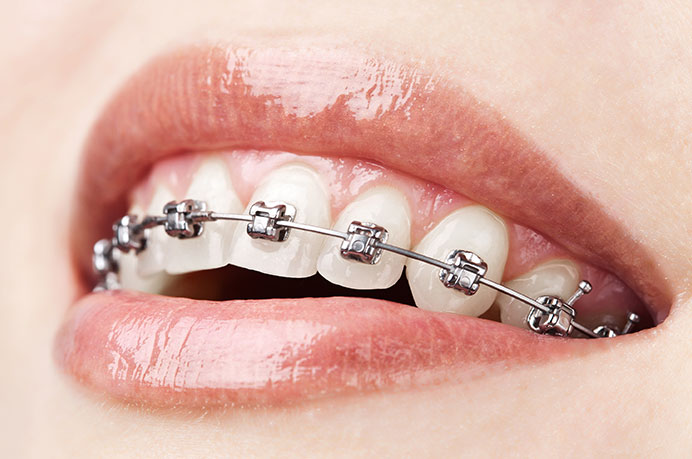 brackets-metalicos