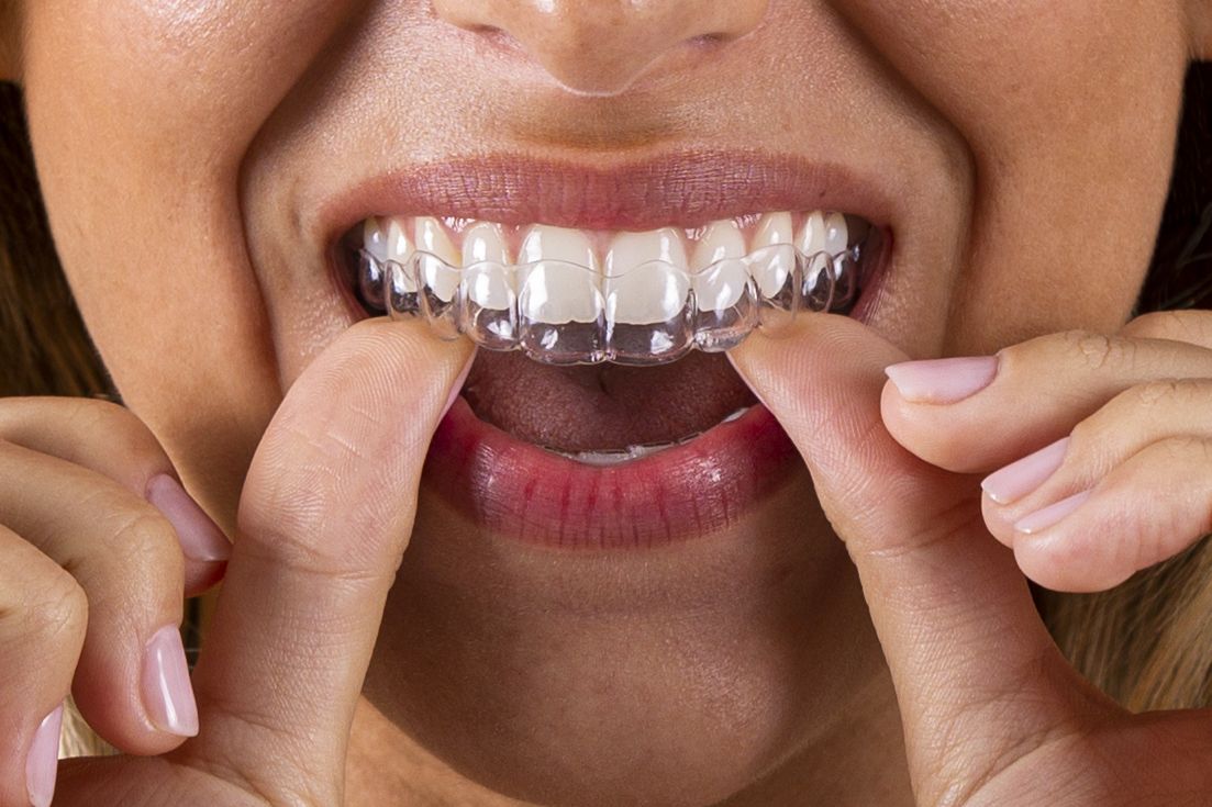 ortodoncia-invisible-quick-smile-que-es-y-como-funciona-top